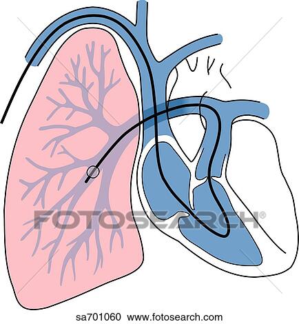 Heart Lung イラスト の 配置 の 白鳥 Ganz Catheter クリップアート 切り張り イラスト 絵画 集 Sa Fotosearch
