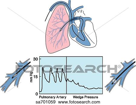 Stock Illustration - Heart/lung illustration of placement of Swan-Ganz catheter (top). Graph of pulmonary wedge pressure upon inflation of catheter (bottom).. Fotosearch
