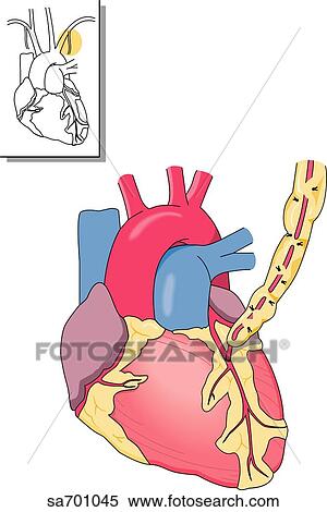 Stock Illustration - Illustration of supplemental blood supply to heart by internal mammary artery after bypass surgery. Orientation drawing (upper left) shows location of mammary artery.. Fotosearch