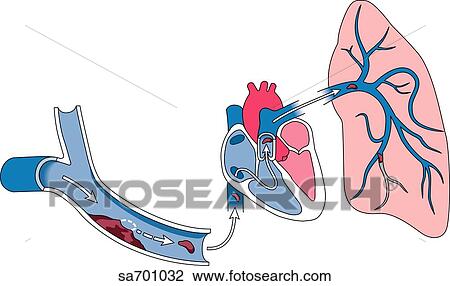 Drawing - Illustration of the generation of an embolus and its route to the lungs.. Fotosearch