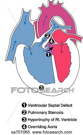 Stock Illustration - Illustration of the set of congenital heart defects referred to as the tetralogy of Fallot; these include: ventricular septal defect, pulmonic valve stenosis, dextroposition of aorta and right ventricular hypertrophy.. Fotosearch
