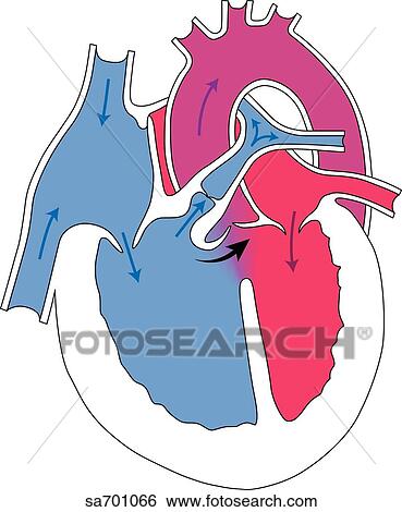 Stock Illustration - Illustration of the set of congenital heart defects referred to as the tetralogy of Fallot (without labels).. Fotosearch