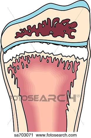 Illustrations of the five classifications of fractures as determined by Salter: Type I. View Large Illustration Clip Art - Illustrations of the five classifications of fractures as determined by Salter: Type I.. Fotosearch