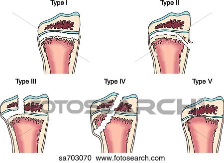 Illustrations of the five classifications of fractures as determined by Salter. View Large Illustration Clipart - Illustrations of the five classifications of fractures as determined by Salter.. Fotosearch