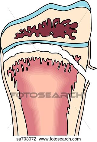 Drawing - Illustrations of the five classifications of fractures as determined by Salter: Type II.. Fotosearch