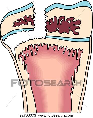 Drawing - Illustrations of the five classifications of fractures as determined by Salter: Type III.. Fotosearch