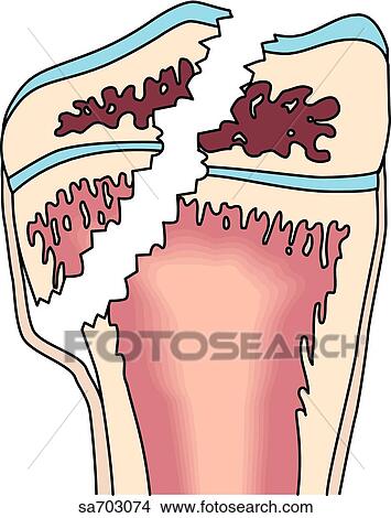 Illustrations of the five classifications of fractures as determined by Salter: Type IV. View Large Illustration Stock Illustration - Illustrations of the five classifications of fractures as determined by Salter: Type IV.. Fotosearch