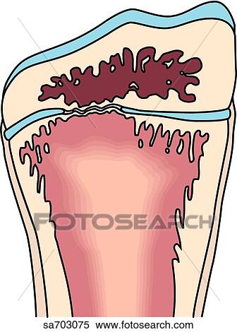 Stock Illustration - Illustrations of the five classifications of fractures as determined by Salter: Type V.. Fotosearch
