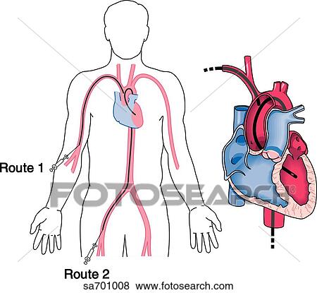 Image on left shows two typical entry points, popliteal and femoral, when doing a cardiac catheterization. The right image shows the routes into the heart via the descending aorta and the subclavian artery. View Large Illustration Stock Illustration - Image on left shows two typical entry points, popliteal and femoral, when doing a cardiac catheterization. The right image shows the routes into the heart via the descending aorta and the subclavian artery.. Fotosearch