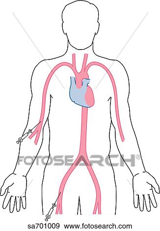 Stock Illustration - Image shows two typical entry points, popliteal and femoral, when doing a cardiac catheterization.. Fotosearch