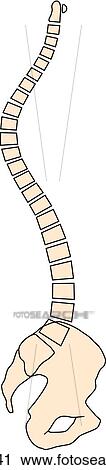 Clip Art - Increased rearward curvature of thoracic spine known as kyphosis.. Fotosearch