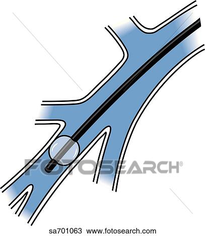 Inflated Swan-Ganz catheter. View Large Illustration Drawing - Inflated Swan-Ganz catheter.. Fotosearch