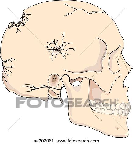 Clip Art - Lateral view of skull with multiple fractures of differing severity.. Fotosearch