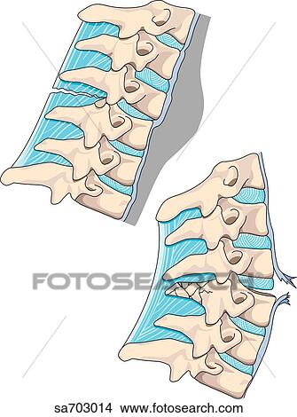 Lateral view of vertebral column showing injury caused by hyperextension and hyperflexion. View Large Illustration Stock Illustration - Lateral view of vertebral column showing injury caused by hyperextension and hyperflexion.. Fotosearch