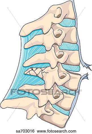 Stock Illustration - Lateral view of vertebral column showing injury caused by hyperextension.. Fotosearch