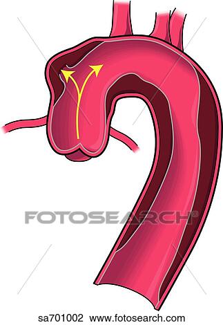 Location of dissecting aneurysm of aorta: type 1. View Large Illustration Drawing - Location of dissecting aneurysm of aorta: type 1.. Fotosearch