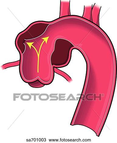 Drawing - Location of dissecting aneurysm of aorta: type 2.. Fotosearch