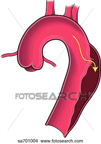Stock Illustration - Location of dissecting aneurysm of aorta: type 3.. Fotosearch