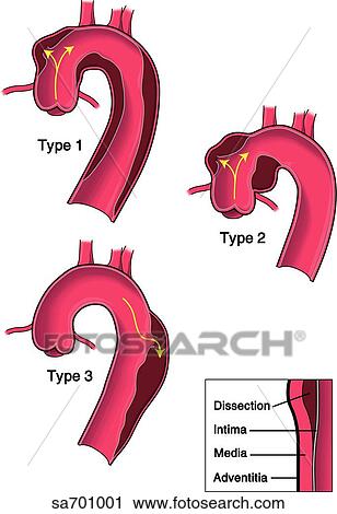 Locations of three types of dissecting aneurysms of aorta shown: type 1 (top left), type 2 (top right) and type 3 (bottom left). Cross-section of wall (bottom right) shows pathological process of splitting of media layer. View Large Illustration Clip Art - Locations of three types of dissecting aneurysms of aorta shown: type 1 (top left), type 2 (top right) and type 3 (bottom left). Cross-section of wall (bottom right) shows pathological process of splitting of media layer.. Fotosearch