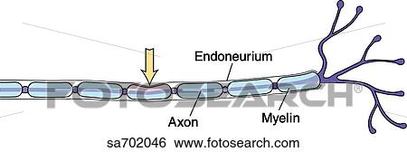 Nerve injury type 1: neuropraxia. View Large Illustration Stock Illustration - Nerve injury type 1: neuropraxia.. Fotosearch