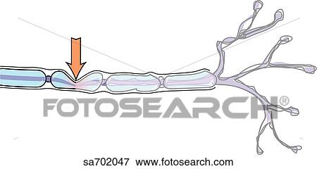Nerve injury type 2: axonotmesis. View Large Illustration Stock Illustration - Nerve injury type 2: axonotmesis.. Fotosearch