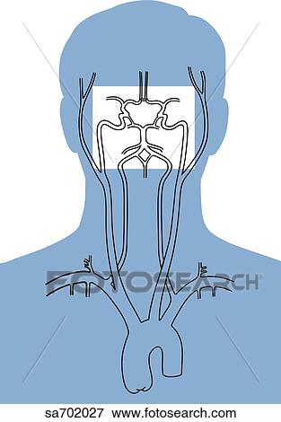 Stock Illustration - Orientation figure shows anatomical location of cerebral aneurysms.. Fotosearch