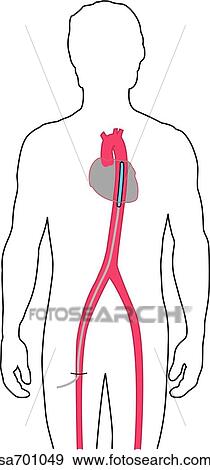 Orientation figure shows location of heart and aorta in body. View Large Illustration Stock Illustration - Orientation figure shows location of heart and aorta in body.. Fotosearch