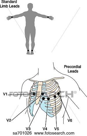 Outline of body (top) with standard limb lead placement for EKG indicated. Torso (bottom) with ...