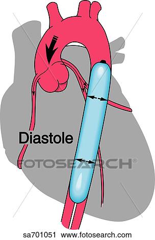 Outline of heart showing action of intra-aortic balloon pump during diastole (inflated). View Large Illustration Clip Art - Outline of heart showing action of intra-aortic balloon pump during diastole (inflated).. Fotosearch