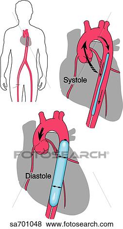 Stock Illustration - Outline of heart showing action of intra-aortic balloon pump during systole (deflated) and diastole (inflated). Orientation figure (upper right) shows location of heart and aorta in body.. Fotosearch