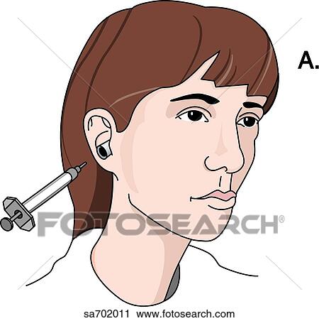 Clip Art - Procedure for conducting Barany's caloric test where the external auditory meatus is irrigated with hot or cold water (step 1).. Fotosearch