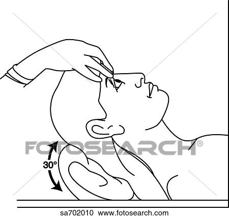 Procedure for conducting Barany's caloric test where the external auditory meatus is irrigated with hot or cold water (insert). View Large Illustration Clipart - Procedure for conducting Barany's caloric test where the external auditory meatus is irrigated with hot or cold water (insert).. Fotosearch
