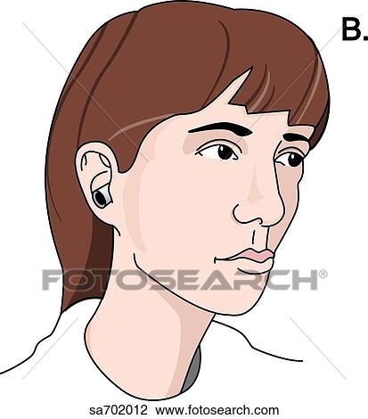 Procedure for conducting Barany's caloric test where the external auditory meatus is irrigated with hot or cold water (step 2). View Large Illustration Drawing - Procedure for conducting Barany's caloric test where the external auditory meatus is irrigated with hot or cold water (step 2).. Fotosearch