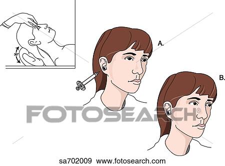 Procedure for conducting Barany's caloric test where the external auditory meatus is irrigated with hot or cold water. View Large Illustration Stock Illustration - Procedure for conducting Barany's caloric test where the external auditory meatus is irrigated with hot or cold water.. Fotosearch