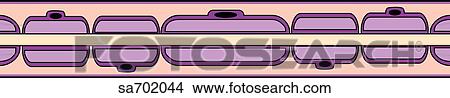 Stock Illustration - Remyelination and subsequent scarring of CNS in multiple sclerosis.. Fotosearch