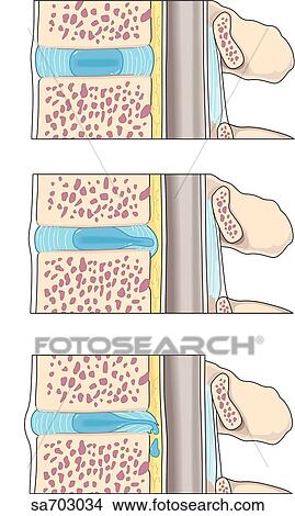 Stock Illustration - Sagittal view of the process of herniation of an intervertebral disc.. Fotosearch
