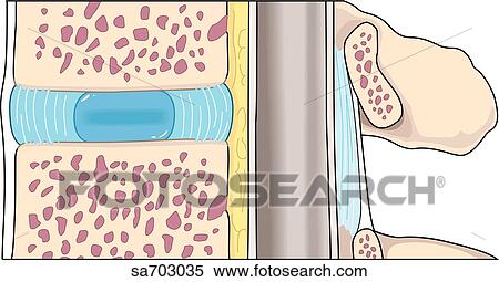 Stock Illustration - Sagittal view of the process of herniation of an intervertebral disc: normal.. Fotosearch