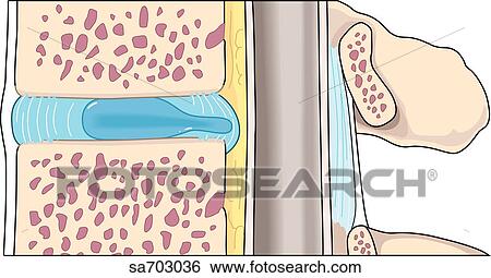 Stock Illustration - Sagittal view of the process of herniation of an intervertebral disc: slipped disc.. Fotosearch