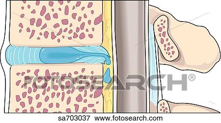 Sagittal view of the process of herniation of an intervertebral disc: step 2. View Large Illustration Stock Illustration - Sagittal view of the process of herniation of an intervertebral disc: step 2.. Fotosearch