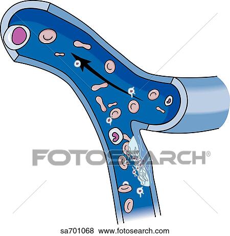 Stock Illustration - Step 1 in the formation of a thrombus within a blood vessel.. Fotosearch