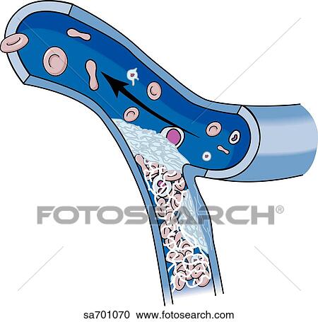 Step 3 in the formation of a thrombus within a blood vessel. View Large Illustration Clipart - Step 3 in the formation of a thrombus within a blood vessel.. Fotosearch
