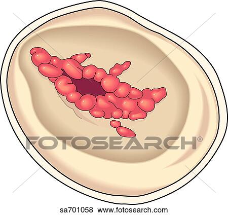 Superior view of heart valve showing damage caused by rheumatic fever. View Large Illustration Stock Illustration - Superior view of heart valve showing damage caused by rheumatic fever.. Fotosearch