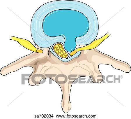 Stock Illustration - Superior view of intervertebral disc showing posterior rupture of inner portion and resulting pressure on the nerve root.. Fotosearch