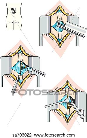 Surgical procedure, shown in three steps, of the excision of an intervertebral disc during discectomy. View Large Illustration Drawing - Surgical procedure, shown in three steps, of the excision of an intervertebral disc during discectomy.. Fotosearch