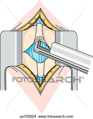 Surgical procedure, step 1, of the excision of an intervertebral disc during discectomy. View Large Illustration Stock Illustration - Surgical procedure, step 1, of the excision of an intervertebral disc during discectomy.. Fotosearch