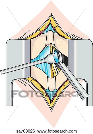 Stock Illustration - Surgical procedure, step 3, of the excision of an intervertebral disc during discectomy.. Fotosearch