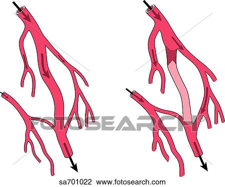 Drawing - System of blood vessels capable of providing more than one route of supply should blockage (right) occur.. Fotosearch