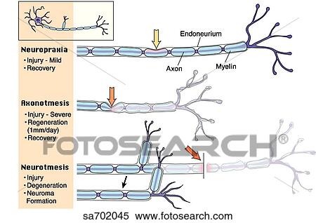 Stock Illustration - Three types of nerve injury.. Fotosearch
