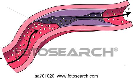 Clipart - Transverse section of blood vessel after clot busting drug has reopened lumen.. Fotosearch