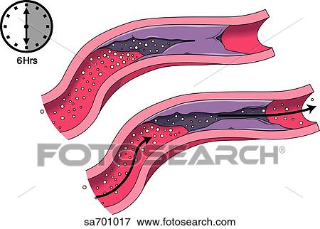 Stock Illustration - Transverse section of blood vessel blocked by clot (top) and after clot busting drug has reopened lumen (bottom). Clock (upper left) indicates passage of time.. Fotosearch